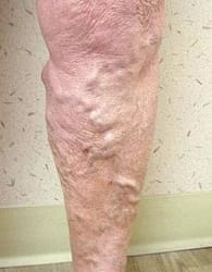 Varicose Vein Treatment Before