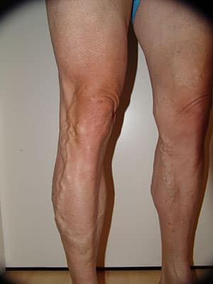 Varicose Vein