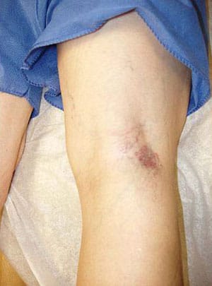 sclerotherapy pretreatment page patient 1