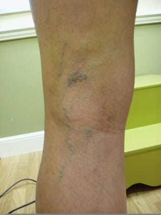 Spider veins before treatment by podiatrist Boynton Beach