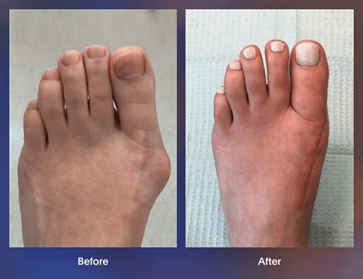 bunion foot min